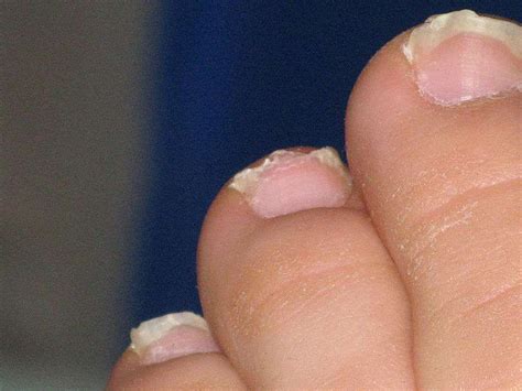 Définition | Ongle incarné