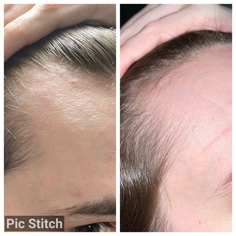 Discover more like Transtimelines: Day 1 -> + 4mo HRT hairline