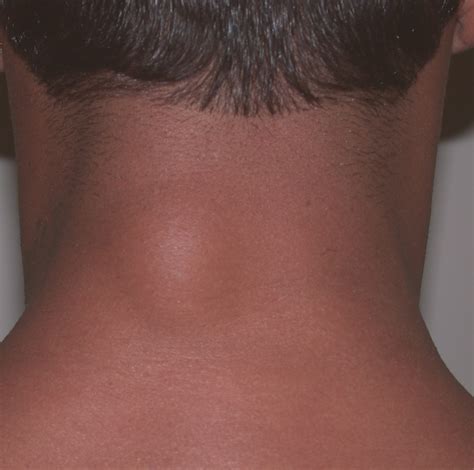 lipoma: April 2010