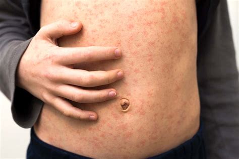 Measles | New Scientist