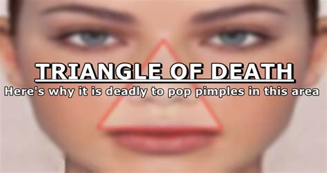 Popping Pimples In The Triangle Is Deadly, Here's Why