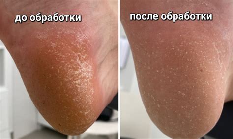 Обработка стоп от гипергидроза — Центр подологии СТОПАМЕР