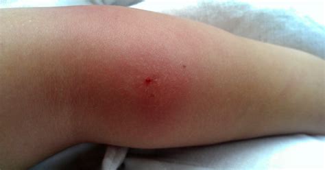 When to see a doctor about an infected insect bite