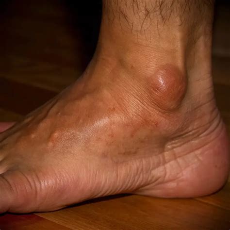 ganglion cyst teton foot ankle center