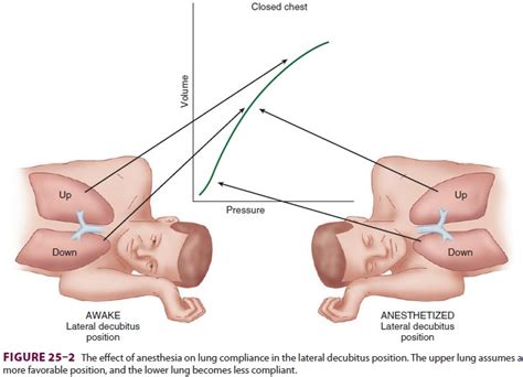 Anesthesia for Thoracic Surgery: The Lateral Decubitus Position