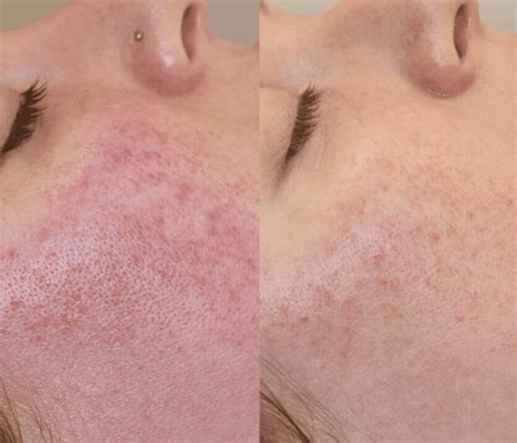 Rosacea & Sensitive Skin Ottawa - Natural Acne Treatments