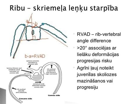 Skolioze
