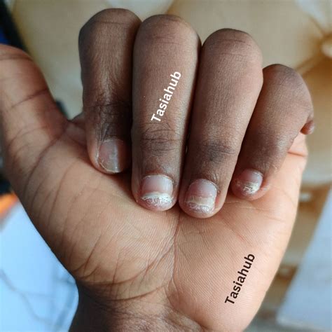 Understanding Onycholysis Of The Nail: Causes, Symptoms And Treatment ...