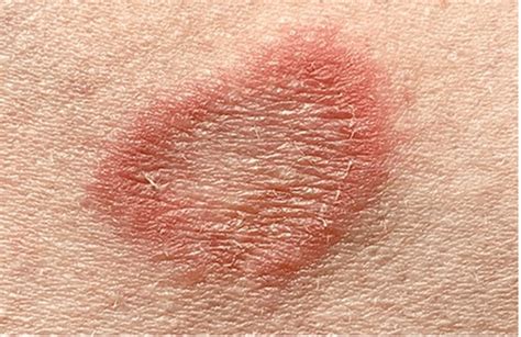 Tinea Corporis in Children, Symptoms, Treatment, Prevention - Dr. Anki ...