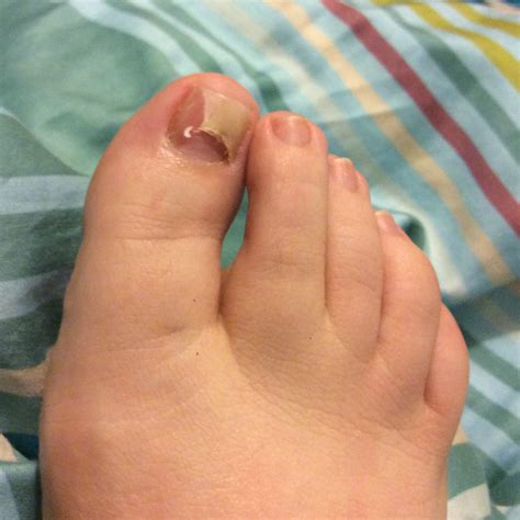 Health: Dealing with a fungal nail infection - HodgePodgeDays