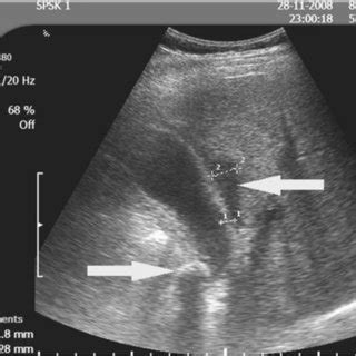 Ultrasound findings in acute cholecystitis that could affect the ...