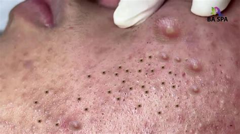 Blackhead Pimple Popping Videos At The Spa at Kevin Christensen blog