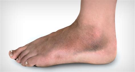 10 Signs of Blood Clot in Foot: Danger Facts