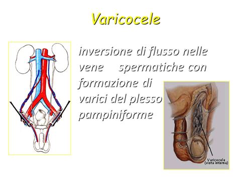 Varicocele - Paolo Dott. Pompa Urologo
