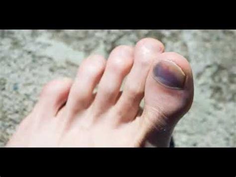Uñas moradas: causas, síntomas y cómo tratar este problema