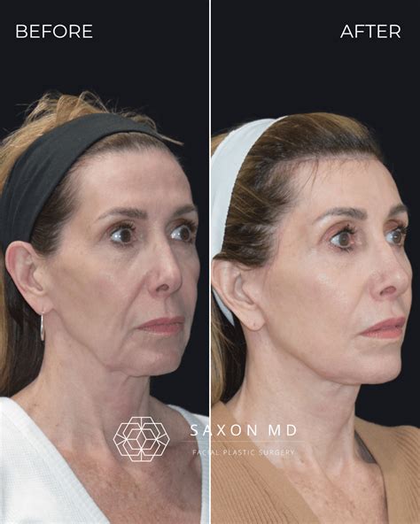 facelift    dr sarah saxon  austin  dallas tx