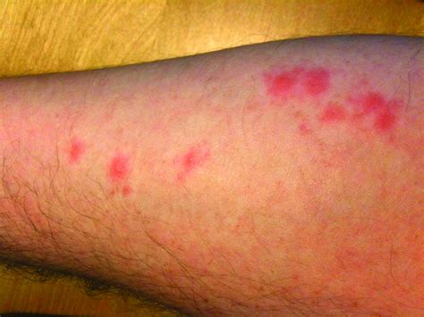 What Do Bed Bug Bites Look Like? | ABC Blog