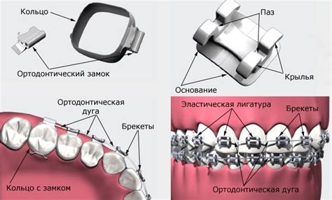 Встановлюємо брекети і брекет-системи в Чернігові - Одонтосфера