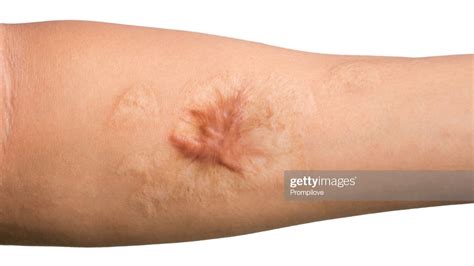 4 Tips for Hypertrophic Scar Management