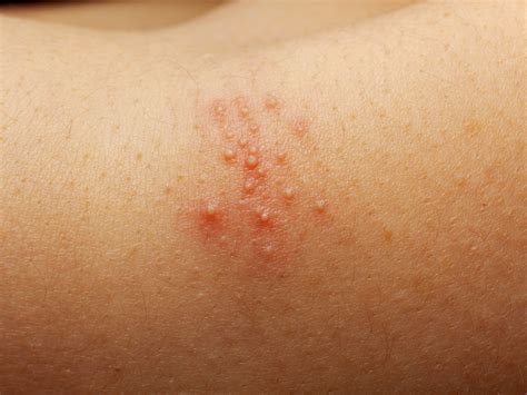 Non Itchy Bumps On Elbows
