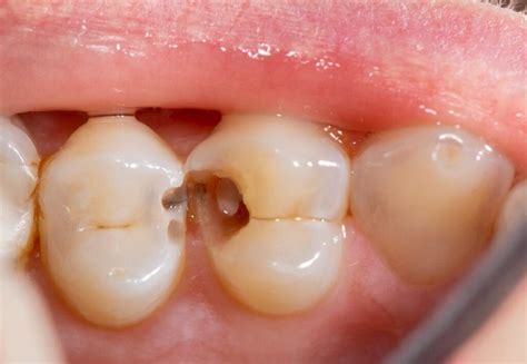 Dental Caries