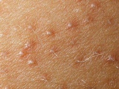 Прыщи на руках- почему чешутся, как лечить прыщи на руках. Причины ...