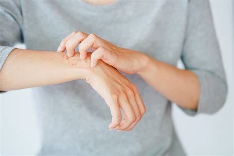 ringworm awareness        health commune