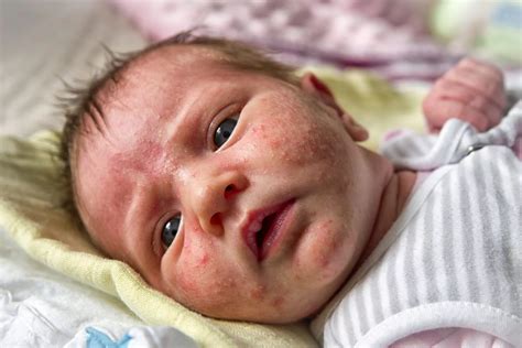 Neonatal Acne - Dr. Eddie's Happy Cappy