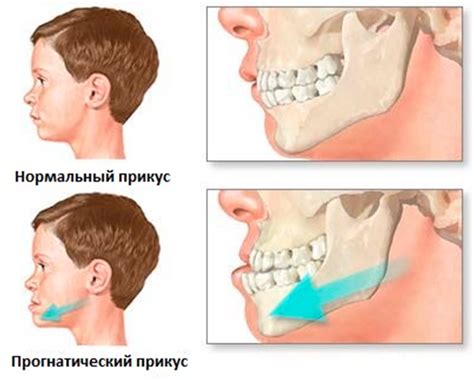 Неправильный прикус
