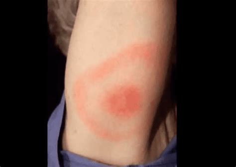 Brown Recluse Bite: Pictures, Stages, Signs & Treatment - HubPages