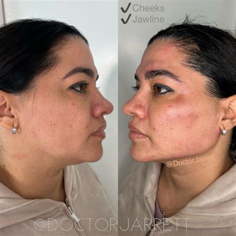 Neck Lift & Décolleté - Designer Aesthetics by Dr. Jarrett Schanzer | Miami