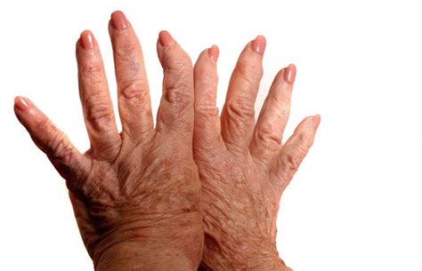 Osteoarthritis: Causes, Symptoms & Treatment | Live Science
