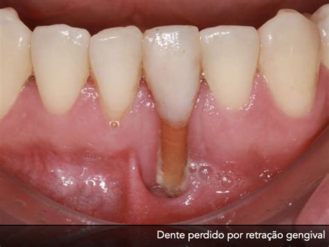 Gengivas Sensiveis O Que Pode Ser - Sensibilidade dentária pode sinalizar algo maior e precisa de ...