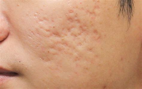 Scarring Skin Care & Treatment - SILK Laser Clinics