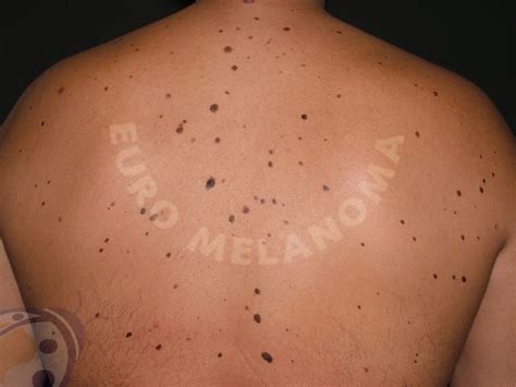 Benign Lesions - Moles - Euromelanoma