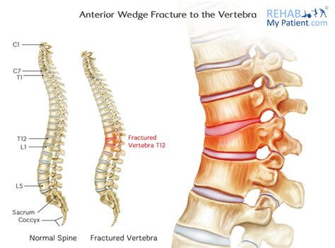 Vertebral fracture