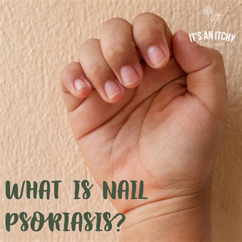 Nail Psoriasis: Causes, Symptoms, and Treatments | itchylittleworld.com