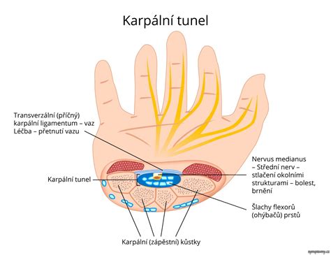 Syndrom karpálního tunelu - příznaky a léčba