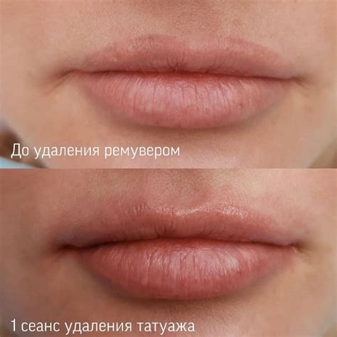 Удаление татуажа: бровей, лазером, ремувер, цена, век, фото, губ, до и ...