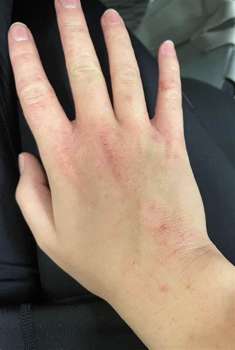Red blotchy skin on arms and hands - allergy or not? : r/eczema