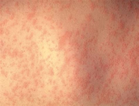 hiv blisters arms