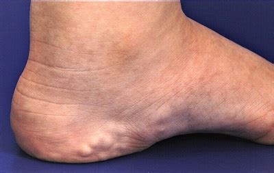 Lumps On The Heel Of Your Foot Online | emergencydentistry.com