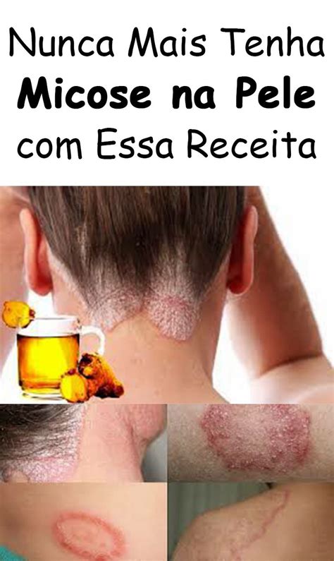 Como Matar Micose Caseiro