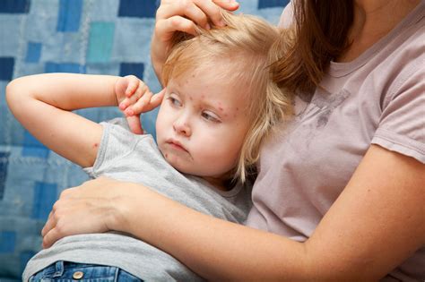 Adult Chicken Pox Symptoms And Treatment For The Virus