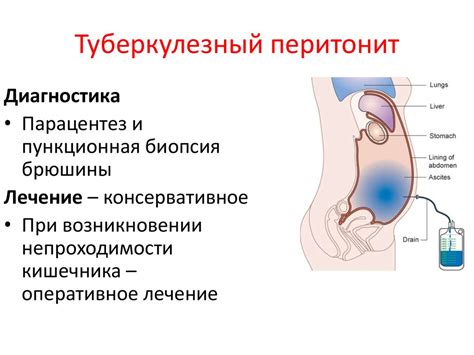 Перитонит. Анатомия Брюшины - online presentation
