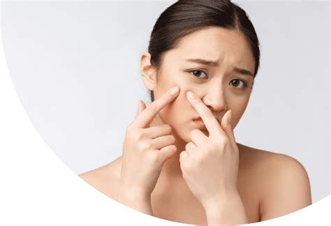 komedo simak penyebab jenis jenis komedo   mengatasinya