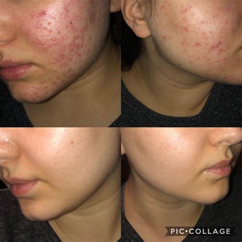 304 best Folliculitis images on Pholder | Folliculitis, Skincare