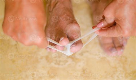 Treatment of hallux valgus. Woman applies valgus splint, silicone
