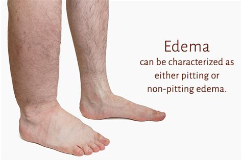 Edema: Stages, Types, Causes, Treatment, Risks - eMediHealth