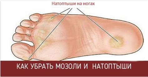 Забудь про мозоли и натоптыши! 8 Эффективных рецептов!